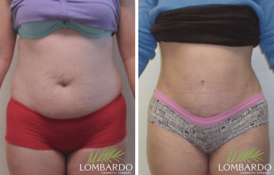 avelar tummy tuck in rancho mirage