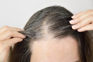Hair loss treatment in Palm Springs