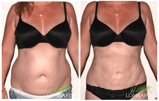 liposuction before and after in rancho mirage