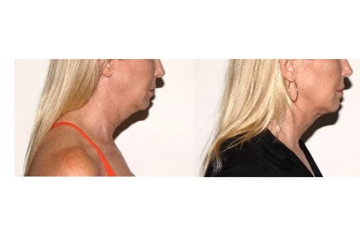 Before and After Image: Liposuction: Patient - front