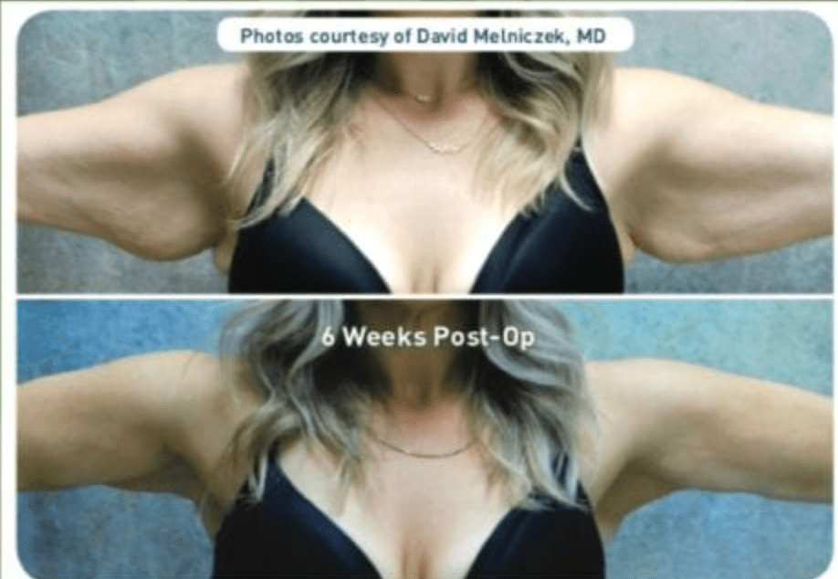 patient’s arms before and after Renuvion™ Skin Tightening, less hanging fat and skin after procedure