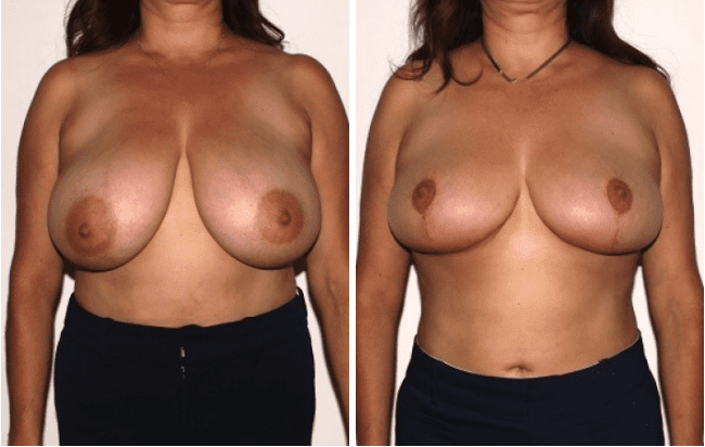 A before and after of a woman that underwent a breast reductions procedure