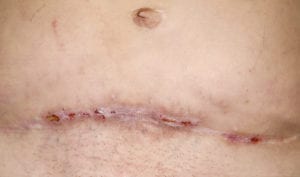 Scars on a persons belly from tummy tuck surgery.
