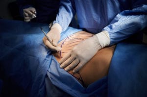 Close up surgeon hands in white sterile gloves using scalpel, doing tummy tuck in operating room. Surgeon cutting patient belly with blue marks on skin. Concept of medicine and abdominoplasty.