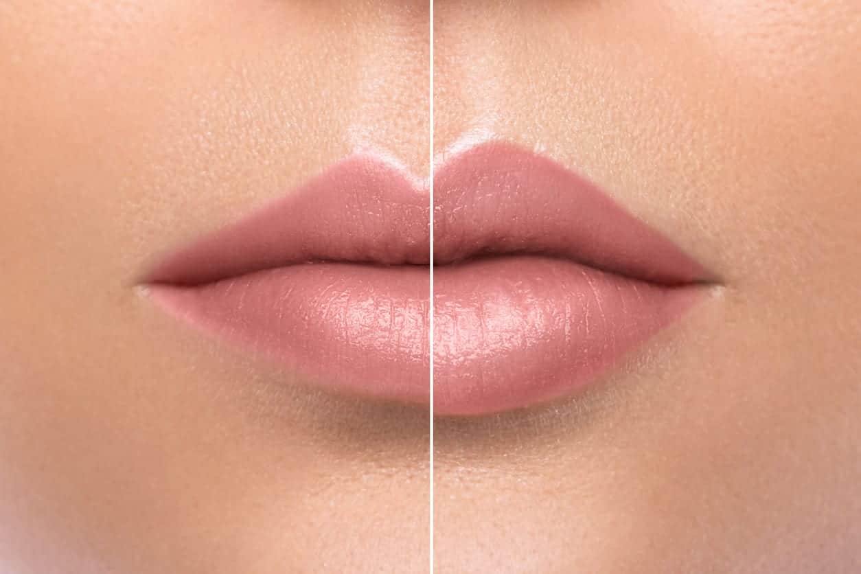 before and after lip augmentation, lips fuller after procedure