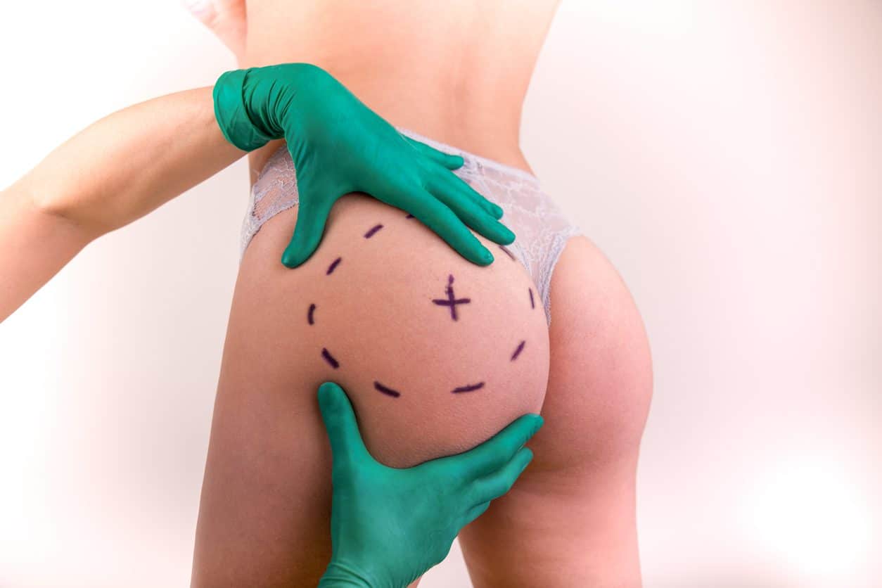 Buttocks Augmentation Procedure