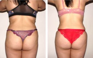 Buttocks Augmentation Procedure