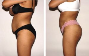 Buttocks Augmentation Procedure