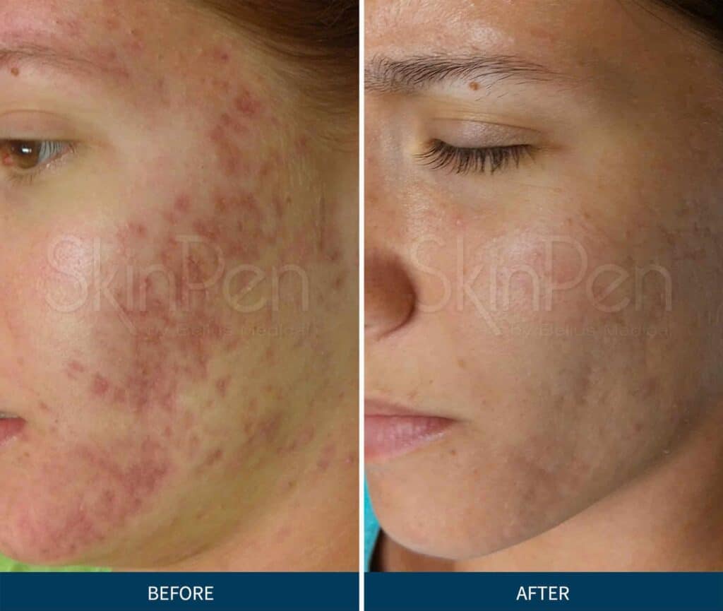 Before & After SkinPen