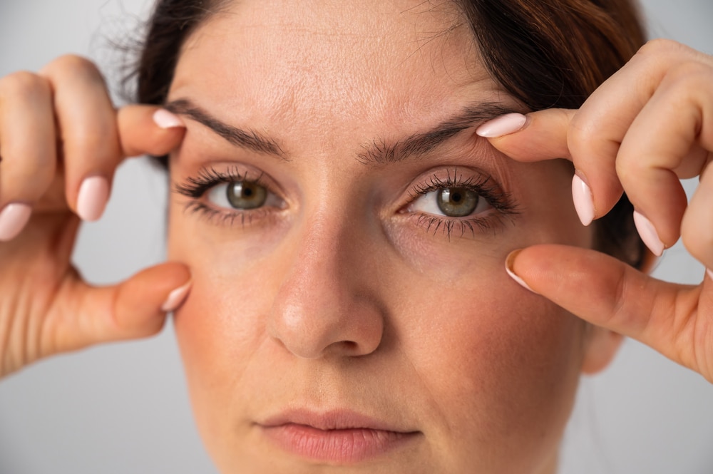 A woman tightening the skin around her eyes before eyelid surgery