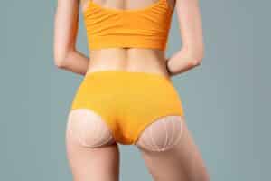 Slim woman with surgical markings on buttocks, concept of liposuction, fat reduction, and cellulite removal on gray background