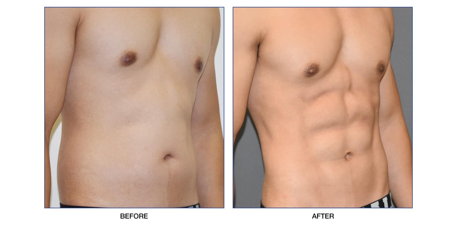 VASERlipo Palm Desert CA