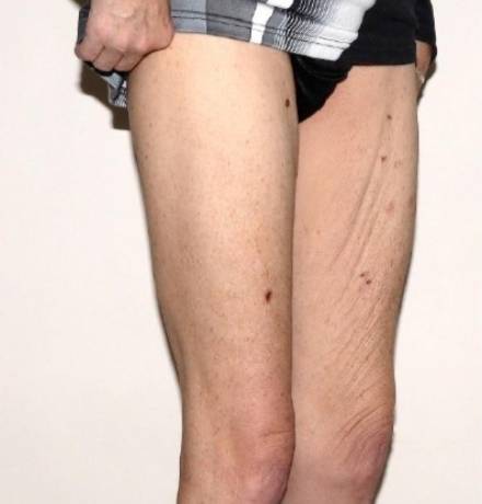 After Image: Renuvion Thighs - right-front-oblique