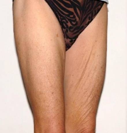 Before Image: Renuvion Thighs - right-front-oblique