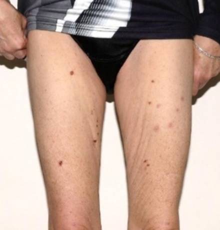 After Image: Renuvion Thighs - front