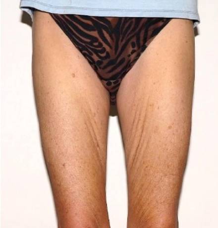 Before Image: Renuvion Thighs - front