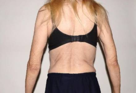 After Image: Renuvion Arms - back