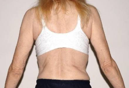 Before Image: Renuvion Arms - back