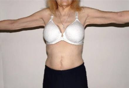 Before Image: Renuvion Arms - front