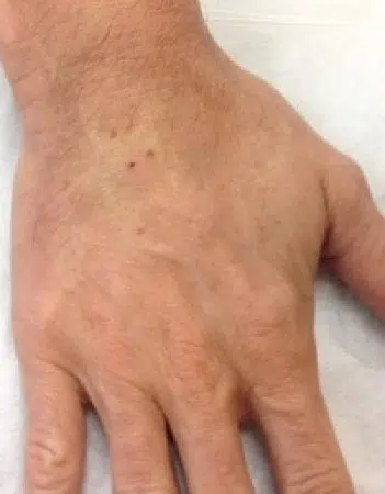 Hand Rejuvenation <br /><small>in Rancho Mirage, CA</small>