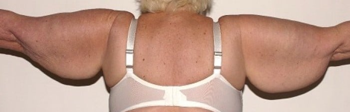 Body Contouring</br><small>In Rancho Mirage, CA</small>